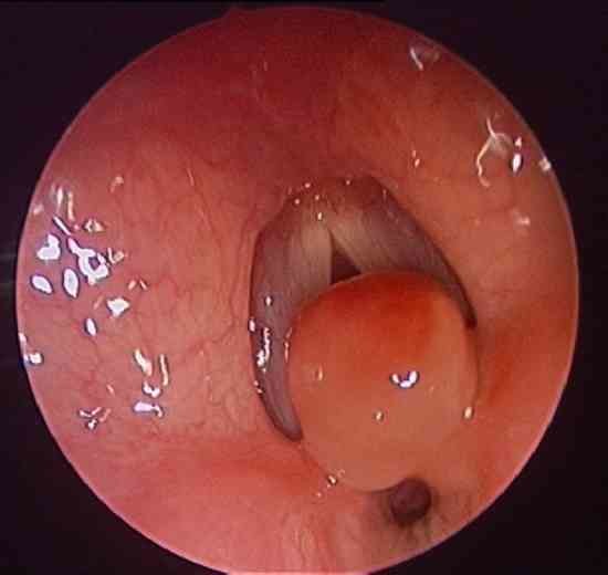 GRANULOME LARYNGÉ POST INTUBATION : GPI